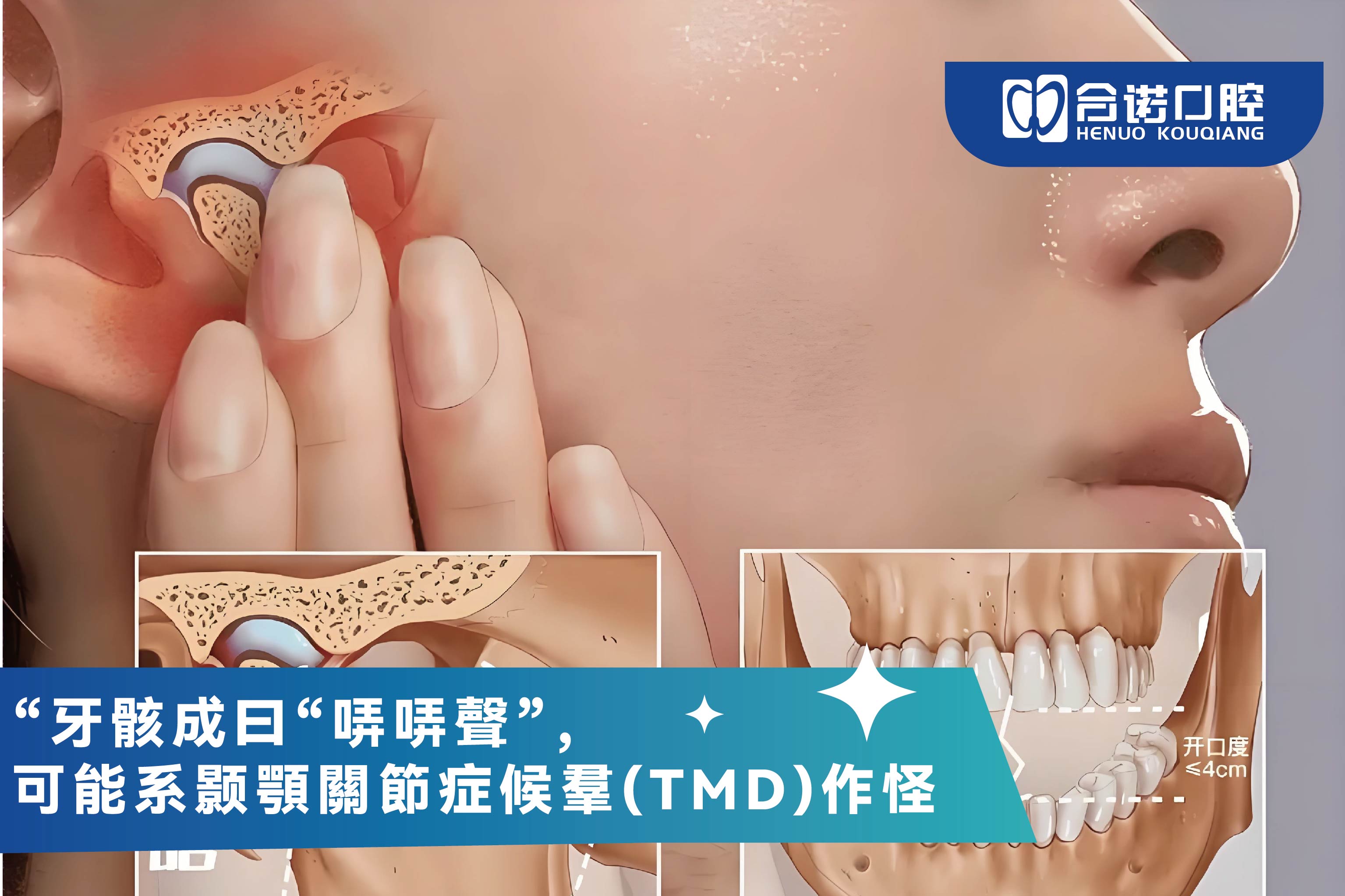 牙骹成日“咔咔聲”，可能系顳顎關節症候羣(TMD)作怪